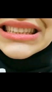 COD Venner Gigi Palsu Instant Original Bisa Pasang Lepas Untuk Dewasa Pria Wanita Tinggal Pakai Terlaris Snap On Smile