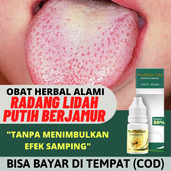 Obat Tetes Lidah Berjamur Obat Radang Lidah Putih Lidah Berjamur