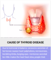 THYROID FUCOIDAN-(Japan) Treatment for thyroid tumor. 