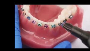 【NEW】Orthodontic Ligature Ties Dental Elastomeric Ligature Ties Orthodontics Elastic O-rings Braces Rubber Bands Tools