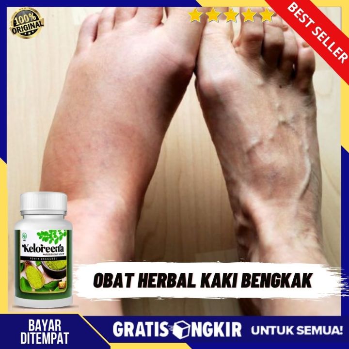 Obat Kaki Bengkak Obat Untuk Sakit Tumit Kaki Bengkak Radang Sendi