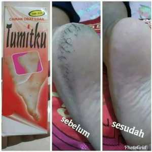 TUMITKU OBAT KAKI PECAH - KAPALAN - mata ikan