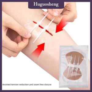 [huguosheng] แถบซิปช่วยลดการเย็บแผลแบบไม่เจ็บอุปกรณ์ช่วยปิดแผลแบบไม่มีเย็บติด