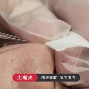Nhíp Gắp Mụn Đầu Đen Cây Nặn Mụn Cao Cấp Bộ Nặn Mụn Chuyên Nghiệp - Dụng Cụ Lấy Mụn