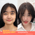 [E-voucher] เหมาขวดโบท็อก Botox เลือกยี่ห้อได้ ลดริ้วรอย ทำหน้าใส ช่วยให้หน้าเรียวเล็ก ย้อนวัยให้หน้าเด็ก จากแฮวอน คลินิก Haewon Clinic. 