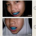 [TAHAP 1] Perapih gigi tonggos original asli Perapih gigi maju ke depan Behel gigi lepas pasang asli original Behel perapih gigi carang gingsul renggang asli dokter Alat perapih gigi monyong Alat perapih gigi maju ori Teeth Trainer Alignment Asli 100% ORI. 