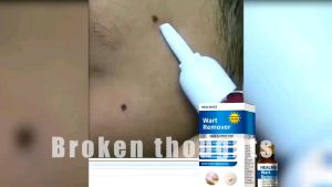 Healmusz Wart Remover: Original Wart Remover & Skin Tag Treatment Cream 10ml