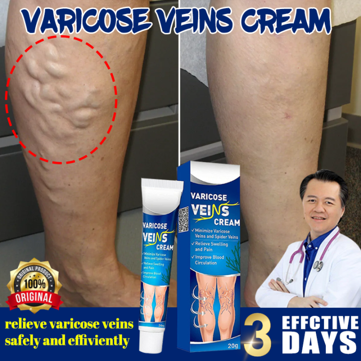 Itchy varicose veins - Enhanceskin