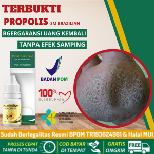 Obat Kaki Rayapan Bolong2 Obat Tumit Kaki Rayapan Dan Bau Pecah2 Obat Jamur di Kaki Obat Telapak Kaki Bolong Berlubang Obat Pitted Keratolysis Obat Kaki Pecah Kering Dengan ProPolis SM