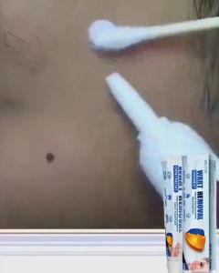 【Local Seller】Warts Cream Remover Painless Skin Tag Moles Plantar Warts Treatment Gentle Fast Acting Foot Face Callus Corn Removal 20g Wart Care Solution