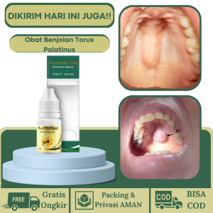 PROPOLI SM 100% ORIGINAL BPOM Obat Benjolan di Langit Langit Mulut Obat Tetes Torus Palatinus Obat Tetes palatum Obat Tetes Penghilang Benjolan Dilangit Mulut Obat Tetes Penghancur Benjolan Di Langit Mulut