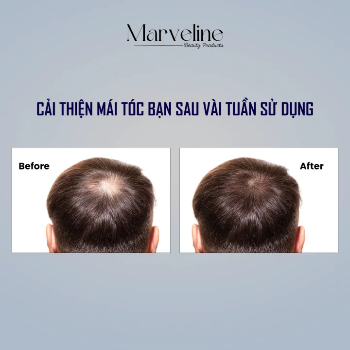 Tinh%20ch%E1%BA%A5t%20kh%E1%BA%AFc%20ph%E1%BB%A5c%20r%E1%BB%A5ng%20t%C3%B3c%20Kaminomoto%20Higher%20Strength%20Nh%E1%BA%ADt%20B%E1%BA%A3n%20ch%C3%ADnh%20h%C3%A3ng%20-%20Image%205