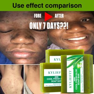 Aloe Brightening Soap Bar Remove Dark Spots Sun Spots Acne Oil Control Clean Stains Exfoliation For Face and Body 200g2026
