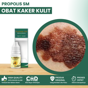 Obat Kanker Kulit Obat Kanker Melanoma Obat Herbal Kanker Kulit Obat Kanker Kulit Di Tangan Dan Kaki Benjolan Berdarah Obat Penghilang Bekas Luka Kanker Di Kulit Obat Benjolan Bercak Hitam Obat Bercak Bersisik Coklat Dengan Propolis SM