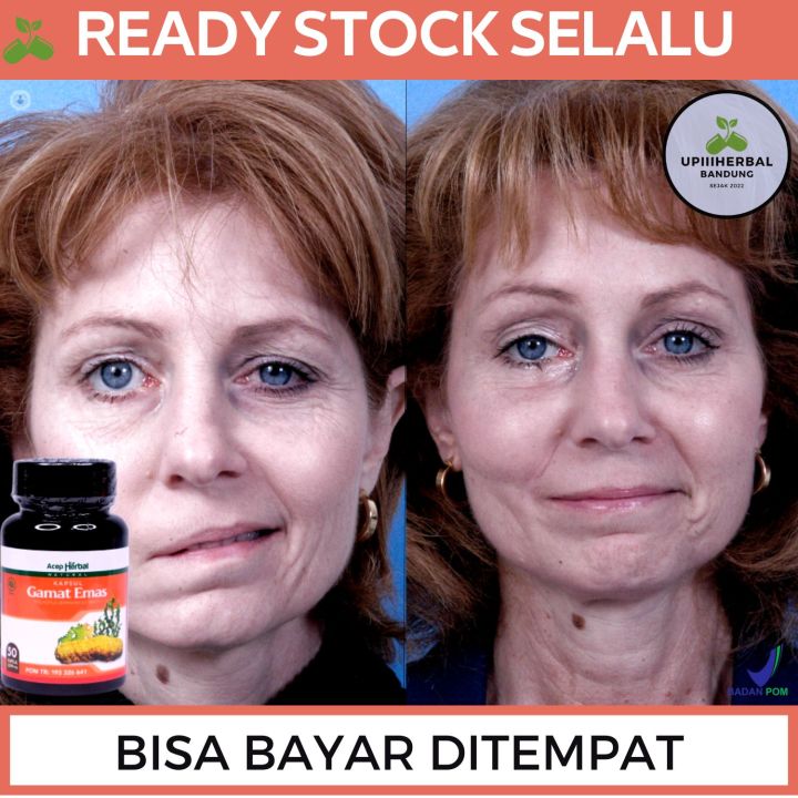 Obat Bells Palsy, Obat Bibir Miring, Obat Untuk Bibir Miring, Obat Wajah Turun Sebelah, Obat Wajah Tidak Simetris, Obat Untuk Otot Wajah Lemah, Obat Wajah Kaku Sebelah, Obat Wajah Turun Sebelah, Obat Penyakit Bells Palsy Dengan Kapsul Gamat Emas
