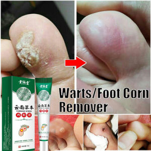 ubat ketuat tapak kaki ketuat remover plaster ketuat wart removal cream Hand Foot Corn Remover corn plaster remover 雞眼貼雞眼藥水雞眼膏肉粒去除