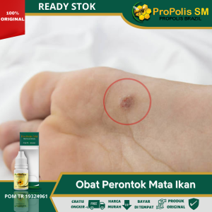Obat mata ikan di telapak kaki Clavus infeksi jamur kulit atasi dengan Propolis SM 100% Herbal Alami