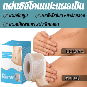 แผ่นซิลิโคนแปะแผลเป็น Multi-Purpose Silicone Scar Sheets แผ่นแปะซิลิโคน แบบม้วน แผ่นดูแลผิวให้เรียบเนียน ลดรอยแผลเป็นนูน
