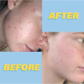 Ego Azclear 20% Azelaic Acid Multi-Purpose Cream Reduces Acne and Fades Dark Spots. 