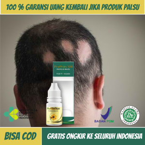 Obat Alopecia Areata Obat Kebotakan Rambut Obat Pitak Obat Penumbuh Rambut Botak Obat Penyakit Autoimun Obat Botak Koin Obat Rambut Pitak Obat Kerontokan Rambut Pada Pria Obat Banyak Pitak Obat Penyubur Rambut Rontok Dengan Propolis SM