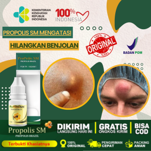 Obat Benjolan Lipoma 100% Asli Alami Obat Benjolan Lipoma Benjolan Di Leher Benjolan Di Tangan Benjolan Di Ketiak Benjolan Di Punggung Pundak Selangkangan Telinga Gondok Hipertiroid Kelenjar Tiroid Limfoma Limpoma Lipoma Kelenjar - ProPolis SM