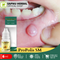 Obat Benjolan di Bibir Mulut, Penghancur Benjolan Di Langit Mulut, Penyakit Mucocele, Kista Mucosa, Benjolan Dalam Mulut, Benjolan Atas Langit Mulut, Benjolan Lidah, Benjolan Kelenjar Langit Mulut, Benjolan Gusi, Benjolan Putih di Bibir Dengan ProPolis SM. 