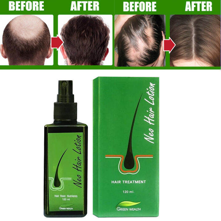 Neo Hair Lotion Herbs 100% Natural Treatment Spray Stop Hair Loss Root ...