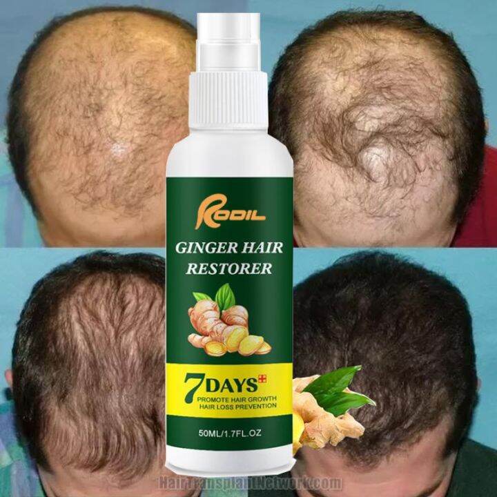 Rodil Hair Growth Oil Hair Growth Ginger Germinal Oil Organic Hair Growth Oils For Hair 8634