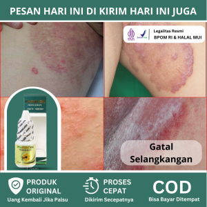 Obat Gatal Selangkangan Obat Oles Selangkangan Hitam Obat Penghilang Gatal Obat Jamur Kulit Obat Pemutih Selangkangan Obat Infeksi Kulit Selangkangan Obat Selangkangan Lecet Eksim Kulit Merah Merah Obat Selangkangan Babak Dengan ProPolis SM