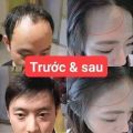 Xịt mọc tóc MINOXIDIL 2%. 