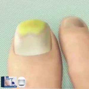 South Moon Nail Fungus Repair Device Effectively Remove Fungal Toenail Painless Fungal Nail Treatment Device Repair Fast Nails Fungus