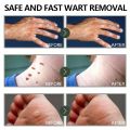 warts remover cream original painless 20g Warts Magic Remover Wartz Removal Cream Warts Remover Skin Kulugo Remover Skin Growth Warts Remover Mole And Warts Remover warts remover cream ointment warts remover original. 