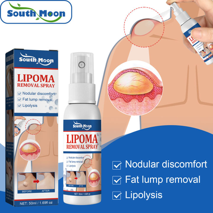 South Moon Lipoma Removal Spray lipoma cream original Relief Pain Treat Skin Swelling Lipolysis Cellulite Fat Lump Nodule Removal Ointment lipoma removal spray