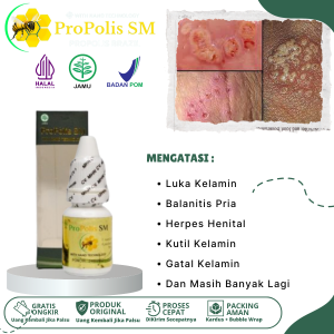 Obat Luka Pada Kelamin Salep Kelamin Lecet Dan Peih Obat Gatal Bintik Kelamin Obat Buah Zakar Bengkak Obat Balanitis Pria Obat Herpes Kelamin Obat Luka Bernanah Di Kelamin Obat Herpes Kelamin Obat Infeksi jamur Dengan Propolis SM