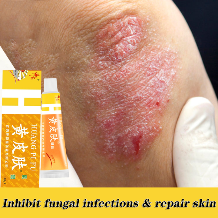 Yellow skin god tyrant yellow skin ointment cream rash itching anti