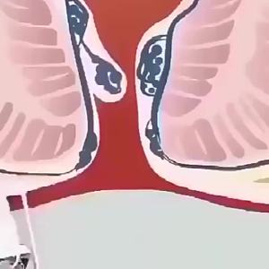 Natural Herbal Hemorrhoids Spray Natural Herbal Hemorrhoids Spray 30ml Remover Hemo Stop Tablet Remove Decayed Tissues Treatment Of External Hemorrhoids Reduces Inflammation Swelling Collapse Atrophy Disappears Shrinks, Hemorrhoids Miracle Ointment