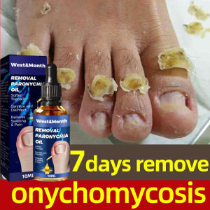 Anti Paronychia Relief Oil Ingrown Toenail Drops Nail Fungal Treatment Nail Repair Essence Nail Care Nail Ingrown Corrector Stop Pain Onychomycosis Treatment Serum 10ml