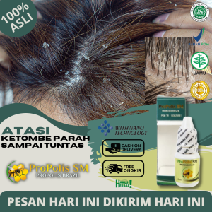 Obat Tetes Ketombe Parah - Obat Kulit Kepala Berkerak Kering Bersisik Obat Psoriasis Kulit Kepala Obat Borok Di Kulit Kepala Obat Kulit Kepala Mengelupas Dengan ProPolis SM