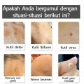Obat Kutil Paling Ampuh Wart Remover Krim Penghilang Kutil Salep Kutil Penghilang Kutil Wajah Menghilangkan Kutil Filiform. 