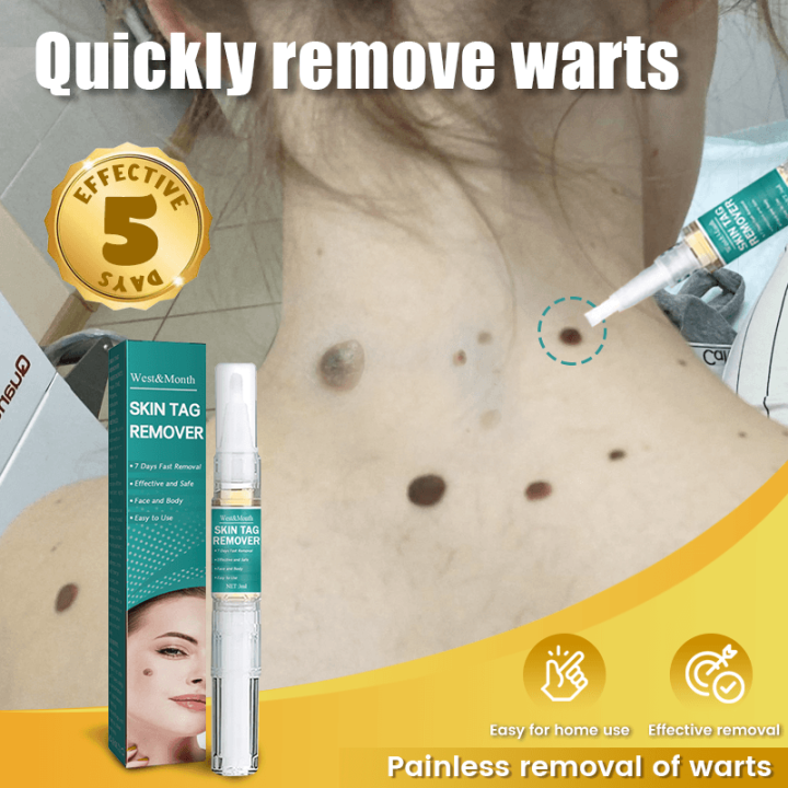 Is Vora Skin Tag Remover Legit warts remover original watson warts removal kasoy oil warts remover