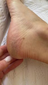 Pedestrian Project Cracked Heel Repair Foot Care Balm Smooths & Fills Cracks & Rough Skin with Healing Shea & Mango Butters Vegan Cruelty Free 1 oz