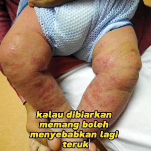 Ready stock🇲🇾(PROMO) Dr.Ridz Soothing Cream Untuk Masalah Eczema Psoriasis & Skin Infection Cream
