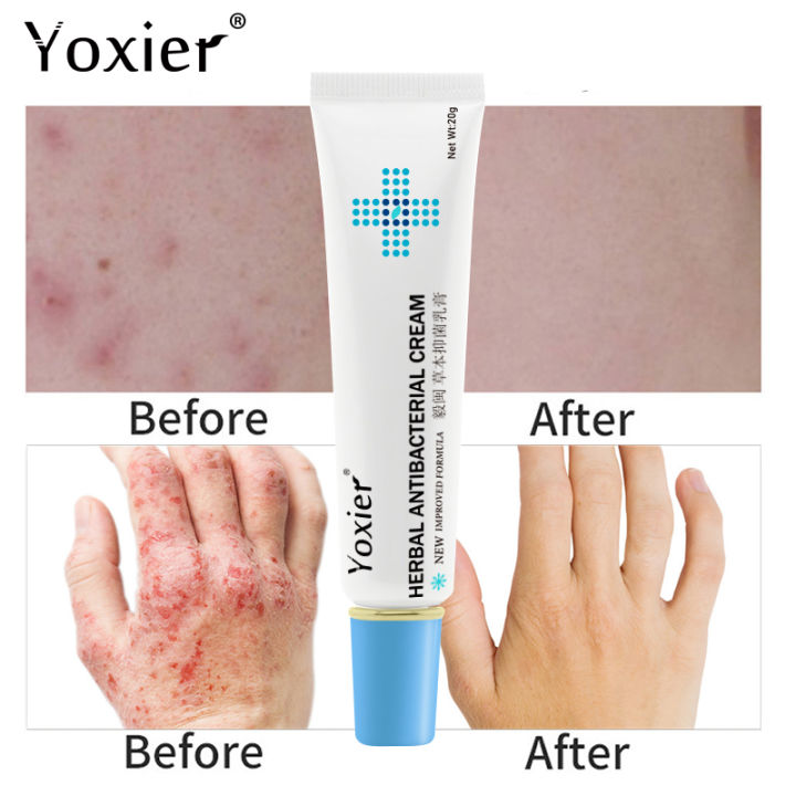 Yoxier Eczema treatment cream gamot sa kati kati sa balat buni ...