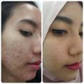 PEMBASMI JERAWAT Obat Jerawat Acnol Lotion ASLI Original 100% Obat Penghilang Bekas Jerawat Obat Jerawat Ampuh Cream Jerawat Obat Anti Jerawat Losion Acnol Pembersih Kulit Wajah Berjerawat Obat Jerawat Paling Ampuh BPOM Lotion Penghilang Jerawat. 