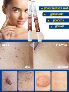 หูด ปากกา สารสกัดจากพืช การดูแล ตุ่น แหนบ ตาไก่ เนื้อ ลบ ปากกา/การดูแลปากกาหูด กําจัดสะเก็ดเนื้อ เกล็ดดํา และตาไก่