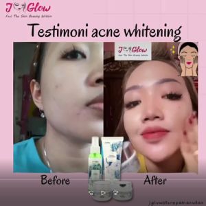 Jglow Skincare Paket Acne solution / Cream Perawatan Wajah Acne Whitening / ORIGINAL / TERLARIS / BEST SELLER / SUBANG