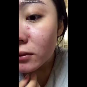 Salicylic Acid Acne Treatment Face Cream Repair Pimple Spots Deep Cleaning Pore Anti-acne Scar Oil Control Moisturizer Skin Care2026