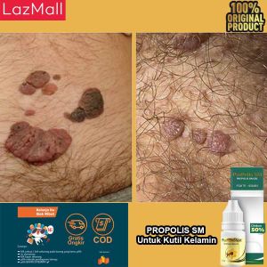 Obat Kutil Kelamin Pria Dan Wanita Benjolan Kutil Perontok Penghilang Kutil Dengan Propolis Brazil SM