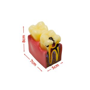1pc Dental Teeth model 6 Times Caries Study Denture Tooth Models Dentist Studying Researching 6 Times Dental Caries Comparison