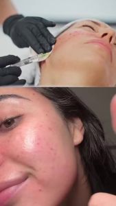 COSRX 5 PDRN Collagen Intense Vitalizing Serum - Serum Hàn Quốc giúp làm săn chắc và làm sáng da với DNA cá hồi rau má Lactobacillus PDRN & Collagen sản phẩm chăm sóc da Hàn Quốc (3.38 fl.oz.)